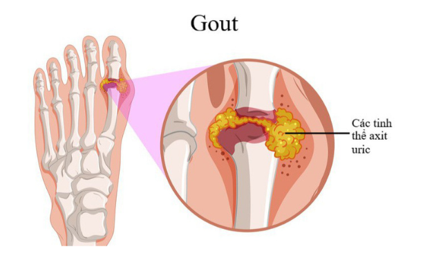 Tim hiểu về bệnh Gout